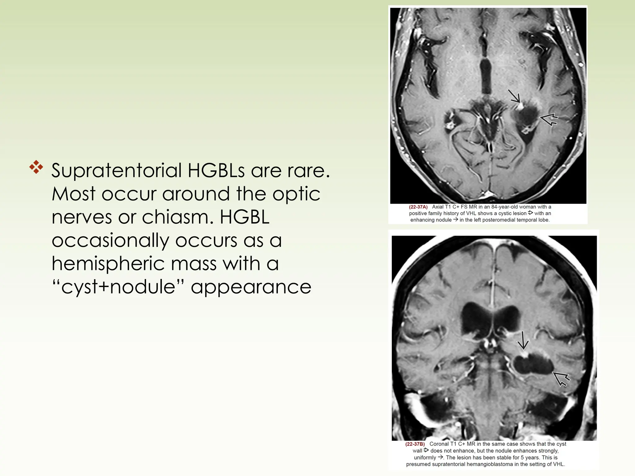  Supratentorial HGBLs are rare.
Most occur around the optic
nerves or chiasm. HGBL
occasionally occurs as a
hemispheric mass with a
“cyst+nodule” appearance
 