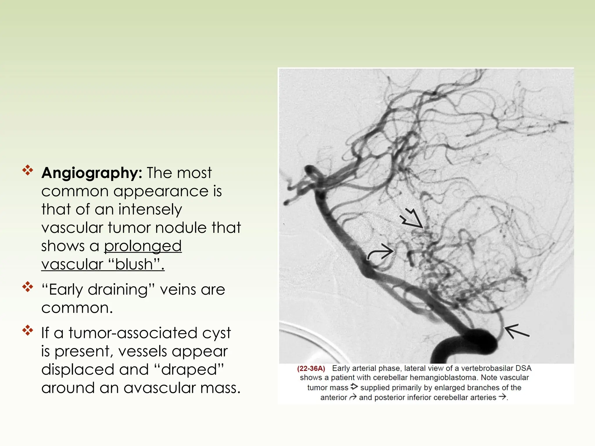  Angiography: The most
common appearance is
that of an intensely
vascular tumor nodule that
shows a prolonged
vascular “blush”.
 “Early draining” veins are
common.
 If a tumor-associated cyst
is present, vessels appear
displaced and “draped”
around an avascular mass.
 