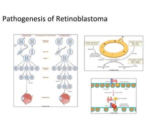 Pathogenesis of Retinoblastoma
 