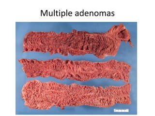 Multiple adenomas
 