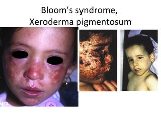 Bloom’s syndrome,
Xeroderma pigmentosum
 