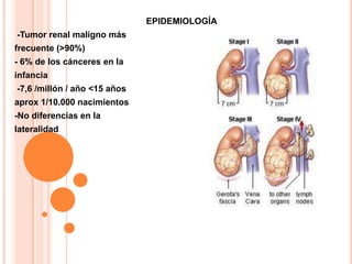 EPIDEMIOLOGÍA<br /> -Tumor renal maligno más<br />frecuente (>90%)<br />- 6% de los cánceres en la<br />infancia<br /> -7,...