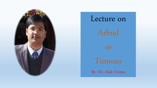 Lecture on
Arbud
or
Tumour
By- Dr. Alok Verma
 