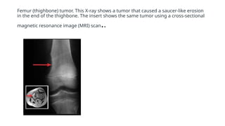 Femur (thighbone) tumor. This X-ray shows a tumor that caused a saucer-like erosion
in the end of the thighbone. The insert shows the same tumor using a cross-sectional
magnetic resonance image (MRI) scan..
 
