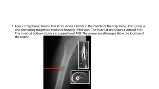 • Femur (thighbone) tumor. This X-ray shows a tumor in the middle of the thighbone. The tumor is
also seen using magnetic resonance imaging (MRI) scan. The insert at top shows a coronal MRI.
The insert at bottom shows a cross-sectional MRI. The arrows on all images show the location of
the tumor.
 