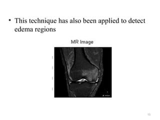 13
• This technique has also been applied to detect
edema regions
 
