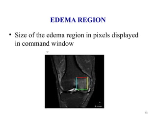 EDEMA REGION
• Size of the edema region in pixels displayed
in command window
15
 