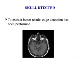 SKULL DTECTED
To extract better results edge detection has
been performed.
9
 