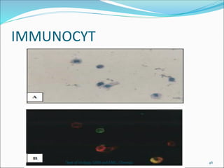 IMMUNOCYT
46
Dept of Urology, GRH and KMC, Chennai.
 