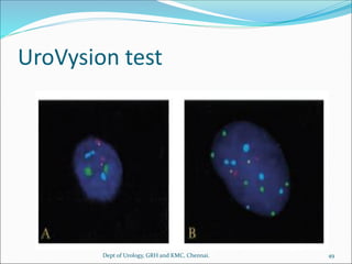UroVysion test
49
Dept of Urology, GRH and KMC, Chennai.
 