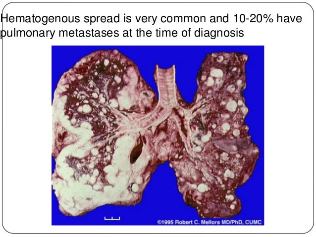 Tumours of bones, cartilage & joints mbbs lect