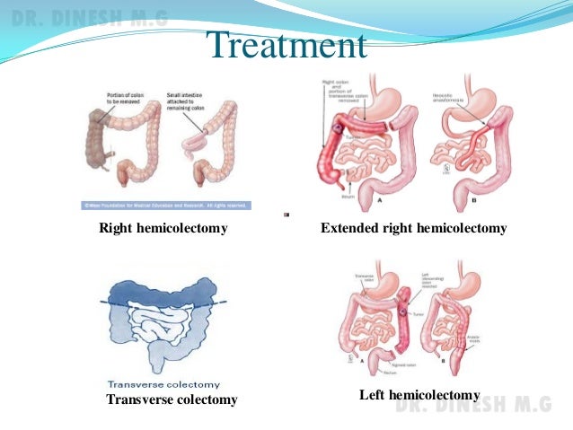 Tumours of Colon and Rectum