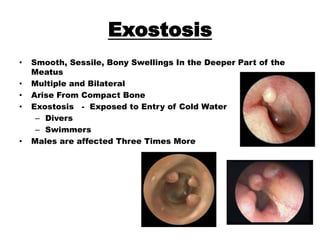 Tumours of Ear | PPTX