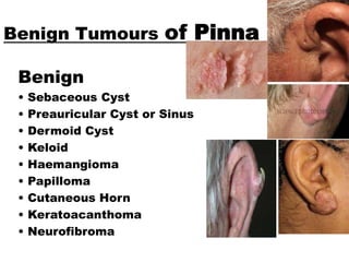 Pinna Sinus Tumours of Ear | PPTX