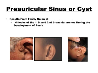 Pinna Sinus Tumours of Ear | PPTX