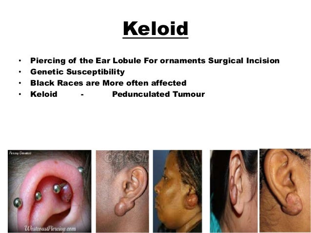 Tumours of Ear