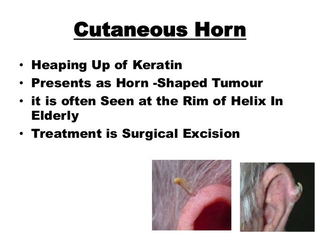 Tumours of Ear