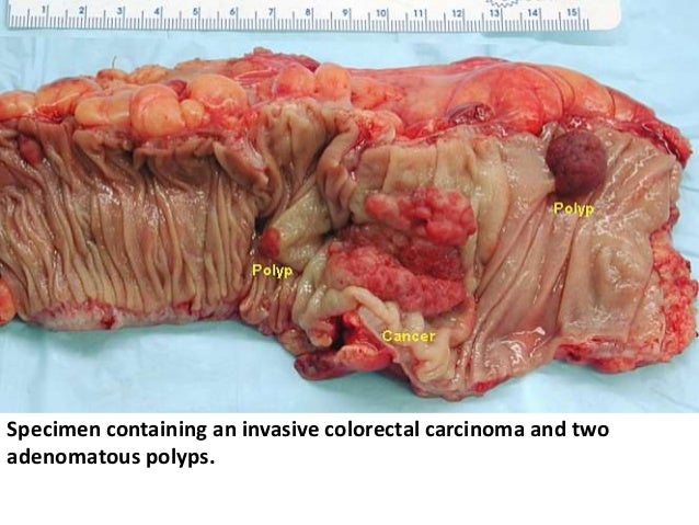 large intestine Key takeaways key points the large intestine starts in the right iliac region of the pelvis, just at or below the right waist, where it is joined to the bottom end. large intestine Key takeaways key points the large intestine starts in the right iliac region of the pelvis, just at or below the right waist, where it is joined to the bottom end.