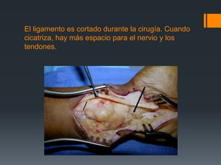 El ligamento es cortado durante la cirugía. Cuando
cicatriza, hay más espacio para el nervio y los
tendones.
 