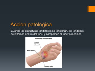 Accion patologica
Cuando las estructuras tendinosas se tensionan, los tendones
se inflaman dentro del túnel y comprimen el nervio mediano.
 