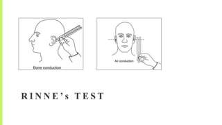 R I N N E ’ s T E S T
 