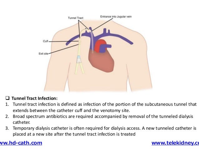 Tunneled catheter insertion
