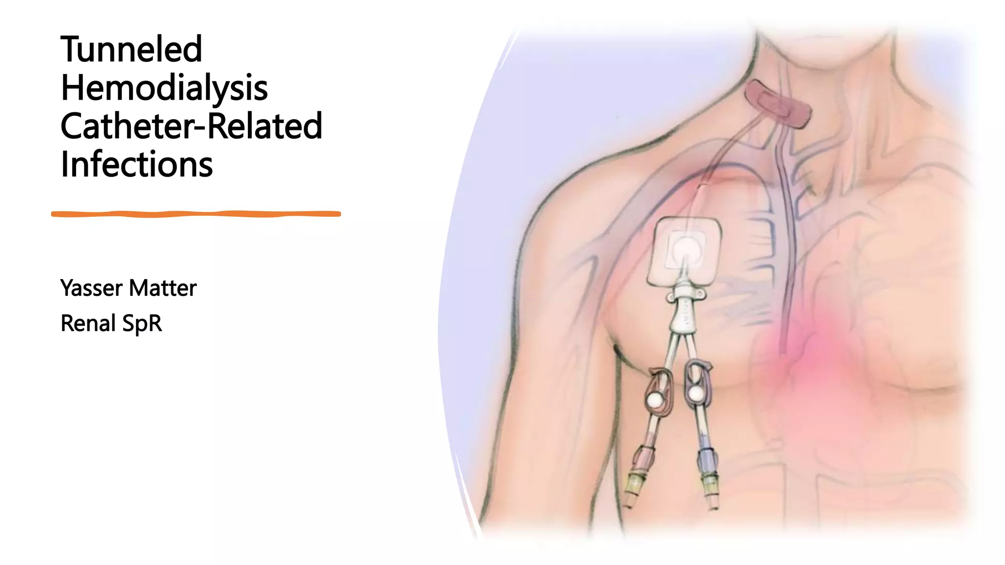 Tunneled Hemodialysis Catheter-Related Infections.pptx