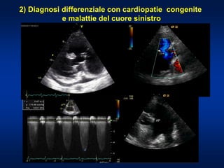 2) Diagnosi differenziale con cardiopatie congenite
e malattie del cuore sinistro
 
