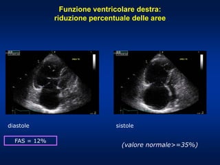 diastole sistole
FAS = 12%
Funzione ventricolare destra:
riduzione percentuale delle aree
(valore normale>=35%)
 