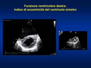 Funzione ventricolare destra:
indice di eccentricità del ventricolo sinistro
 
