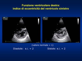 Diastole: e.i. = 2 Sistole: e.i. = 2
(valore normale = 1)
Funzione ventricolare destra:
indice di eccentricità del ventricolo sinistro
 