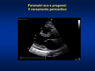 Parametri eco e prognosi:
Il versamento pericardico
 