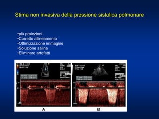 Stima non invasiva della pressione sistolica polmonare
•più proiezioni
•Corretto allineamento
•Ottimizzazione immagine
•Soluzione salina
•Eliminare artefatti
 
