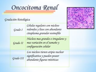 Gradación histológica
Oncocitoma Renal
Grado I
Células regulares con núcleos
redondos y lisos con abundante
citoplasma granular eosinofilo
Grado II
Núcleos mas grandes e irregulares y
mas variación en el tamaño y
configuración celular
Grado III
Los núcleos tienen atipia nuclear
significativa y pueden poseer
abundante figuras mitóticas
 