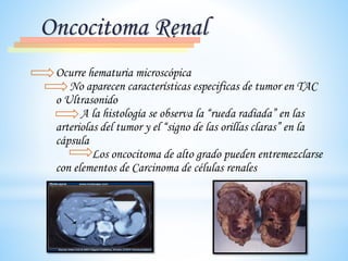 Oncocitoma Renal
Ocurre hematuria microscópica
No aparecen características especificas de tumor en TAC
o Ultrasonido
A la histología se observa la “rueda radiada” en las
arteriolas del tumor y el “signo de las orillas claras” en la
cápsula
Los oncocitoma de alto grado pueden entremezclarse
con elementos de Carcinoma de células renales
 