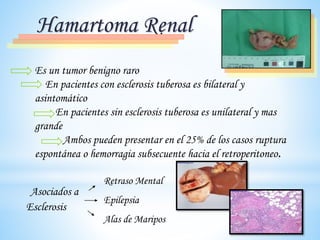 Hamartoma Renal
Es un tumor benigno raro
En pacientes con esclerosis tuberosa es bilateral y
asintomático
En pacientes sin esclerosis tuberosa es unilateral y mas
grande
Ambos pueden presentar en el 25% de los casos ruptura
espontánea o hemorragia subsecuente hacia el retroperitoneo.
Asociados a
Esclerosis
Retraso Mental
Epilepsia
Alas de Maripos
 