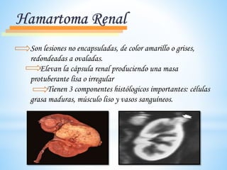 Son lesiones no encapsuladas, de color amarillo o grises,
redondeadas a ovaladas.
Elevan la cápsula renal produciendo una masa
protuberante lisa o irregular
Tienen 3 componentes histólogicos importantes: células
grasa maduras, músculo liso y vasos sanguíneos.
Hamartoma Renal
 