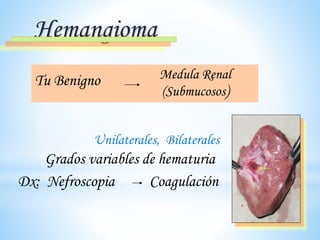 Hemangioma
Tu Benigno Medula Renal
(Submucosos)
Unilaterales, Bilaterales
Grados variables de hematuria
Dx: Nefroscopia Coagulación
 