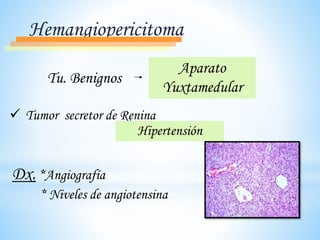 Hemangiopericitoma
Tu. Benignos
Aparato
Yuxtamedular
 Tumor secretor de Renina
Dx. *Angiografía
* Niveles de angiotensina
Hipertensión
 