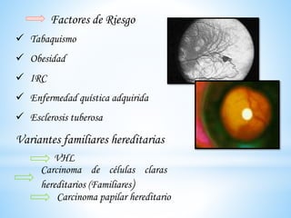 Factores de Riesgo
 Tabaquismo
 Obesidad
 IRC
 Enfermedad quística adquirida
 Esclerosis tuberosa
Variantes familiares hereditarias
VHL
Carcinoma papilar hereditario
Carcinoma de células claras
hereditarios (Familiares)
 