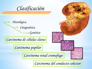 Clasificación
Histológica
Citogenética
Genética
Carcinoma de células claras
Carcinoma papilar
Carcinoma renal cromofogo
Carcinoma del conducto colector
 