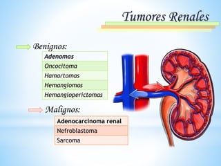 Tumores Renales
Benignos:
Adenomas
Oncocitoma
Hamartomas
Hemangiomas
Hemangioperictomas
Malignos:
Adenocarcinoma renal
Nefroblastoma
Sarcoma
 