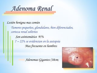 Adenoma Renal
Mas frecuente en hombres
Lesión benigna mas común
Tumores pequeños, glandulares, bien diferenciados,
corteza renal solitrios
Son asintomático 95%
7 – 22% se evidencian en la autopsia
Adenomas Gigantes (10cm)
 