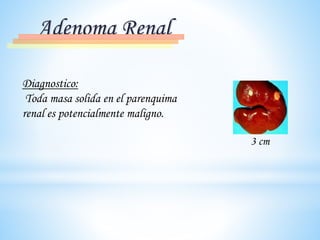Adenoma Renal
Diagnostico:
Toda masa solida en el parenquima
renal es potencialmente maligno.
3 cm
 