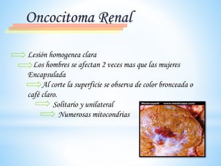 Oncocitoma Renal
Lesión homogenea clara
Los hombres se afectan 2 veces mas que las mujeres
Encapsulada
Al corte la superficie se observa de color bronceada o
café claro.
Solitario y unilateral
Numerosas mitocondrias
 