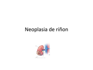 Neoplasia de riñon
 