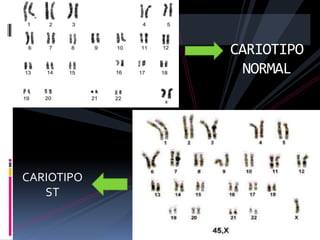 CARIOTIPO
NORMAL

CARIOTIPO
ST

 