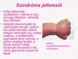 Szindróma jellemzői
• Külső jellemzők:
születéskor: ödéma a kéz-,
és/vagy lábháton, tarkótáji
laza bőrredő
• átlagnál alacsonyabb és
vékonyabb termet, nyakon
két oldalt bőrredő, tarkón
mélyen lehúzódó haj, széles
mellkas, a mellbimbók
egymástól távol vannak, a
gerinc esetleg ferdült ,a
karok enyhén kifelé
fordulnak könyöktől,x-láb,
rövid ujjak,kövér kezek és
lábak
ödéma:
folyadékfelhalmozódás a
szövetekben.
 