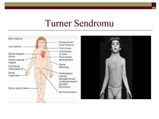 Turner Sendromu
 