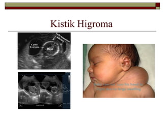 Kistik Higroma
 